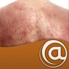 Atopic Dermatitis