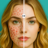 Blemish Remover&Acne: Acnefix