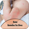 Home Remedies For Hives