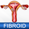 Uterine Fibroid Treatment Help