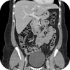 CT Abdomen Pelvis